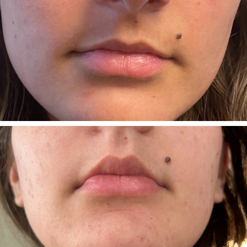 Before and after lip flip