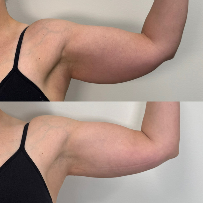 Before and after of a woman who had a BodyTite procedure done at Horizon Med Spa and Wellness in Kansas City.