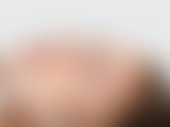 Chemical Peel Aftercare: The Do’s and Don’ts for Faster Healing