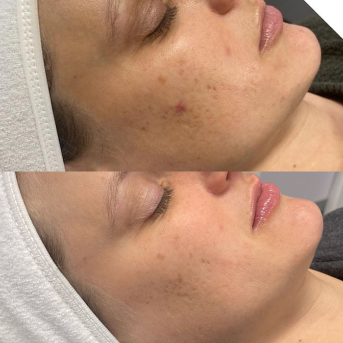 A before and after comparison of a woman with a Morpheus8 Microneedling Treatment by Horizon Med Spa.