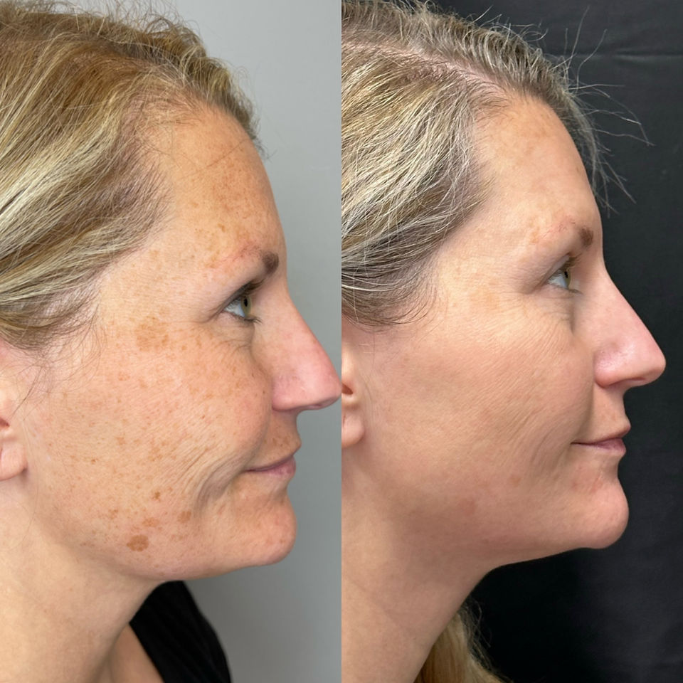 Before and after of a woman who got an IPL treatment at Horizon Med Spa and Wellness.