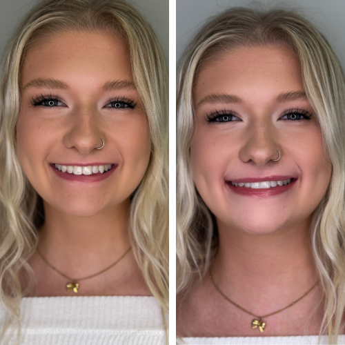 Before and after 1 syringe of lip filler