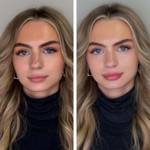 Before and after 1/2 syringe lip filler
