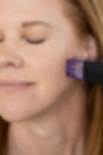 morpheus8-microneedling-treatment-on-woman