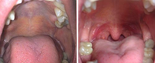 Before and after of Fotona Nightlase