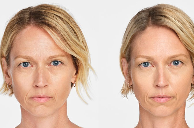 Before & after of Radiesse collagen-stimulating filler