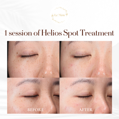 Before & after of helios spots treatment: dark spots removal.