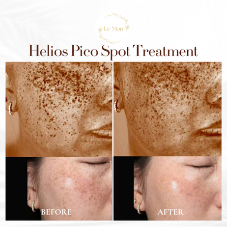 Before & after of helios spots treatment