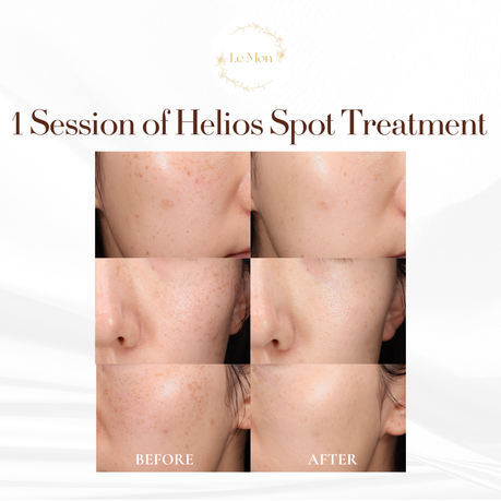 Before & after of helios spots treatment: freckles removal.