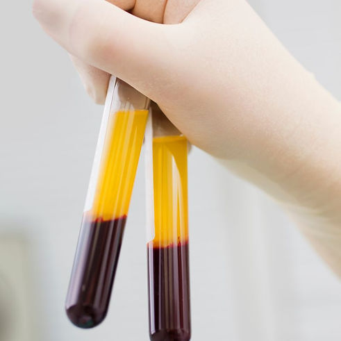 PRF-Platelet-Rich Fibrin-at-le-mon-spa.jpg