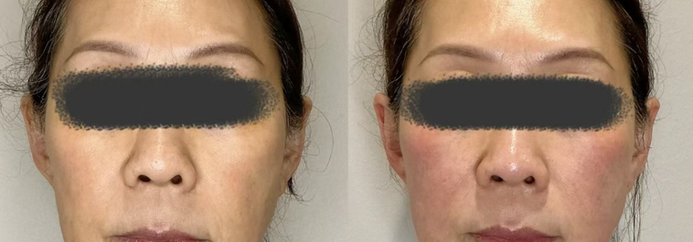 Before & After of Ulthearpy Neck Tightening