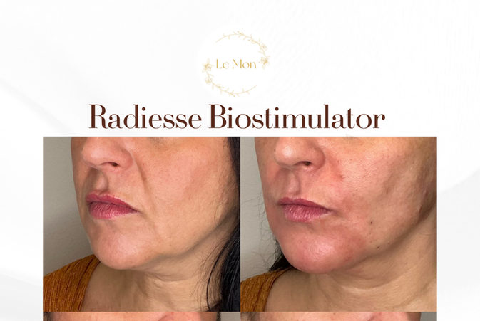 Radiesse biostimulator Before & After