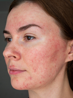 Damaged skin