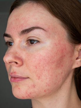 Damaged skin