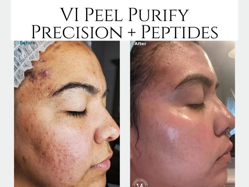 VI Peel Purify Precision + Peptides