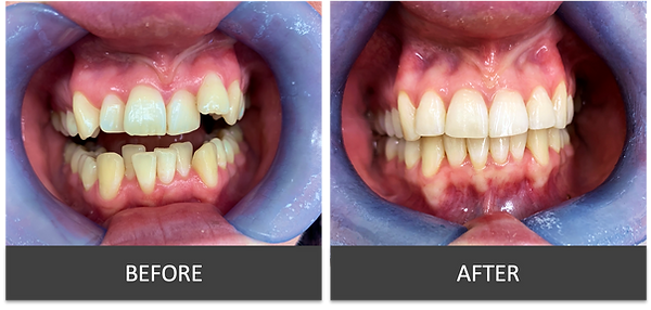 Invisalign before and after.png