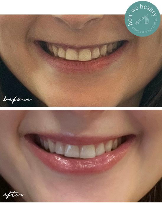 Before & After lip filler: fuller, more defined lips