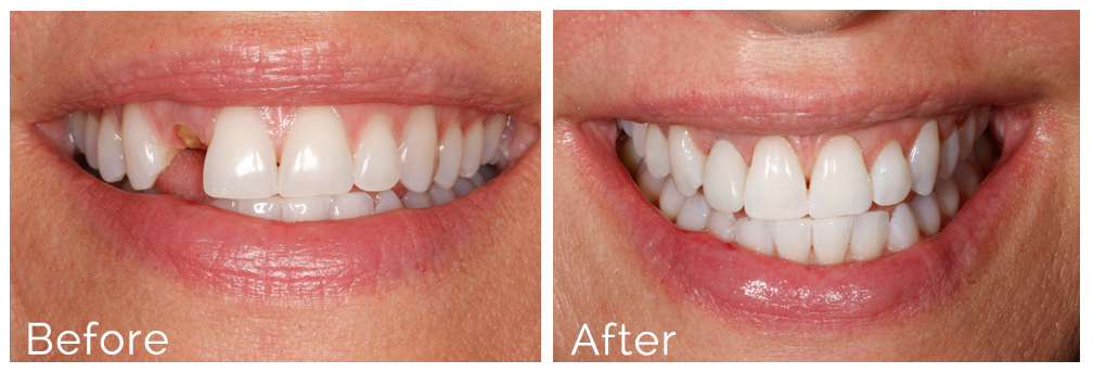 Nhs Dentures Before And After  : Before & After Browse Through The Before And After Photo Transformations Below Created By Changing Faces® Dentures.