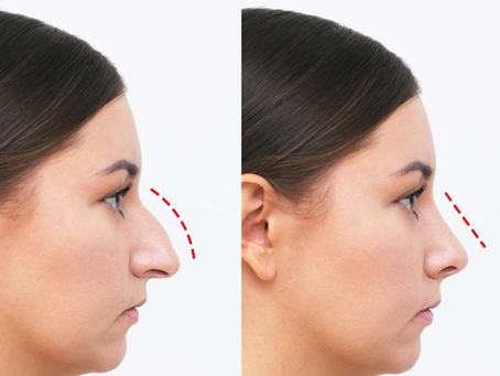 Rhinoplasty Personalized Nose Enhancement That Feels Truly Yours