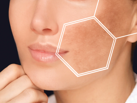 How To Remove Pigmentation From Face Permanently The Right Way