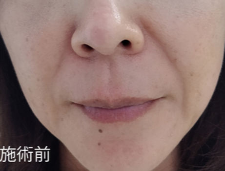 ヒアルロン酸治療縦2_edited.jpg