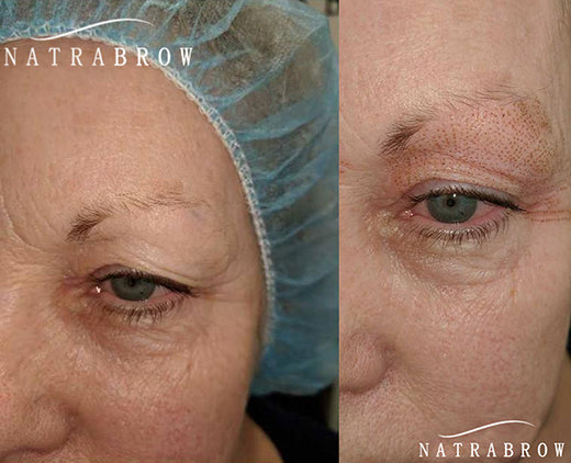 Fibroblast Natrabrow