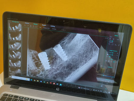 Are you looking for a dental implants in sembakkam at affordable price?