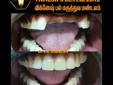 Dental implants near me