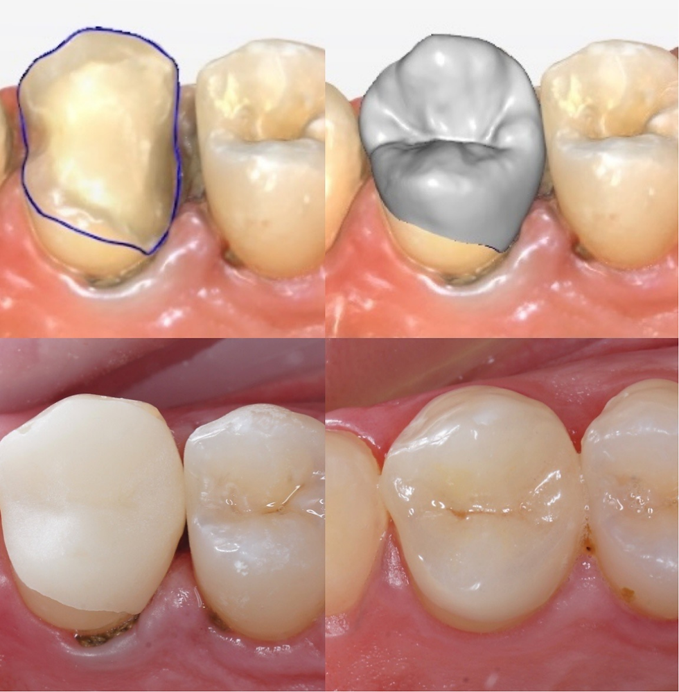 Коронка за один визит
