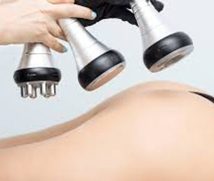 RF cavitation.jpeg