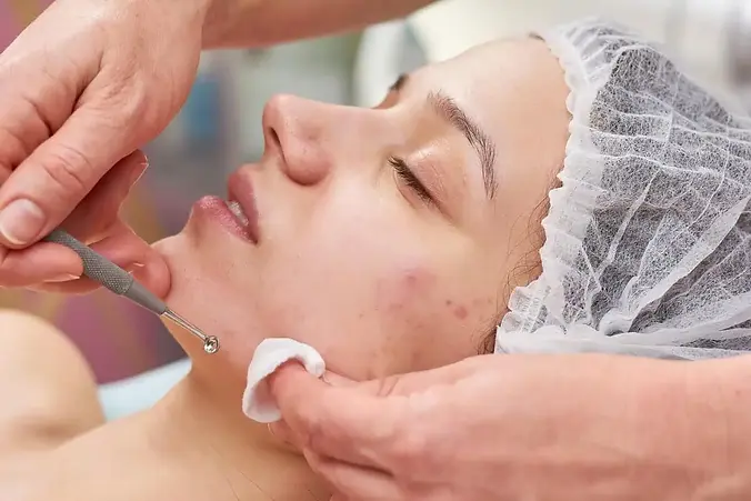 acne.webp