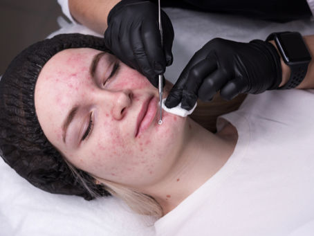 How Pimple Facial Treatments Can Clear Your Skin?