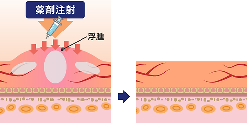 さがみ中央眼科 黄斑浮腫に対する抗VEGF療法