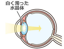 さがみ中央眼科 白内障