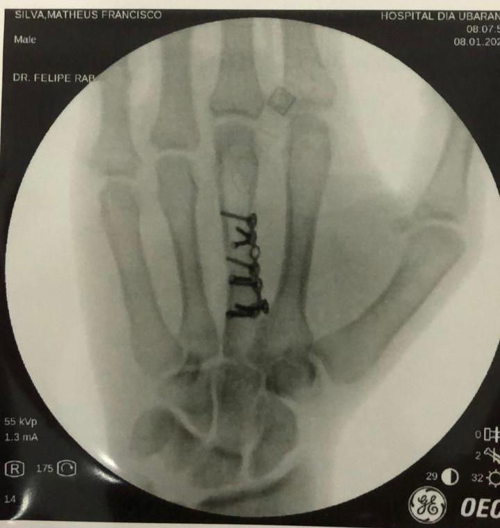 radiografia da mão esquerda de Matheus Francisco após a cirurgia. (foto arquivo pessoal)