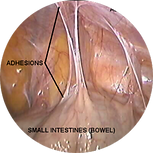 ADHESIONS-1b.jpg