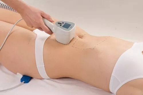 exilis-elite-radiofrecuencia.webp