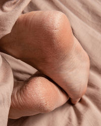 Why Are My Heels So Dry and Cracked?