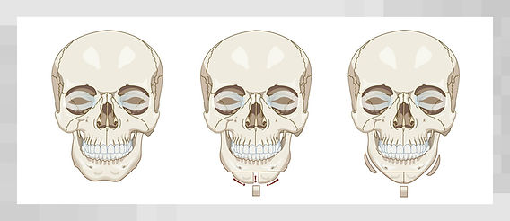 Facial Bone Contouring: Complications and How to Manage