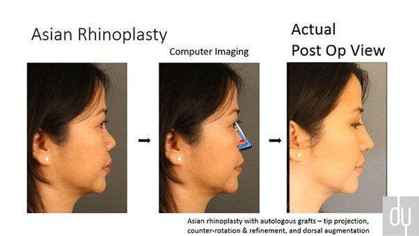 Ageing Related Fat Pad Loss