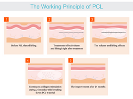 Trends and Evolution of Thread Lifting: PDO vs PLLA vs PCL