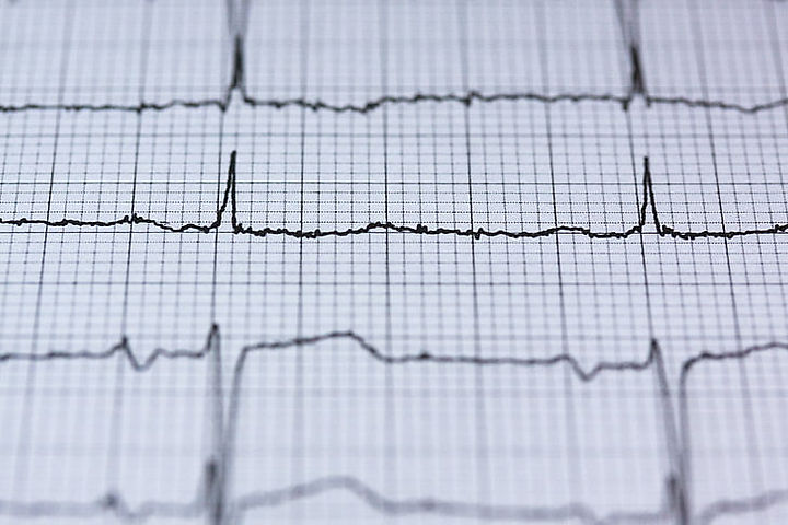 ecg-electrocardiogram-medical-heartbeat-preview.jpg