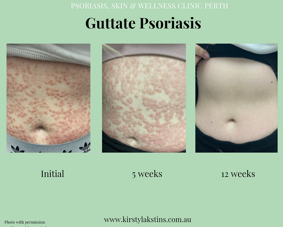 Guttate psoriasis transformation