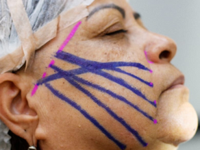 Qual o Melhor Curso de Harmonização Facial do Brasil