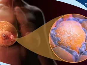 Male Breast Cancer: The Often Overlooked Reality