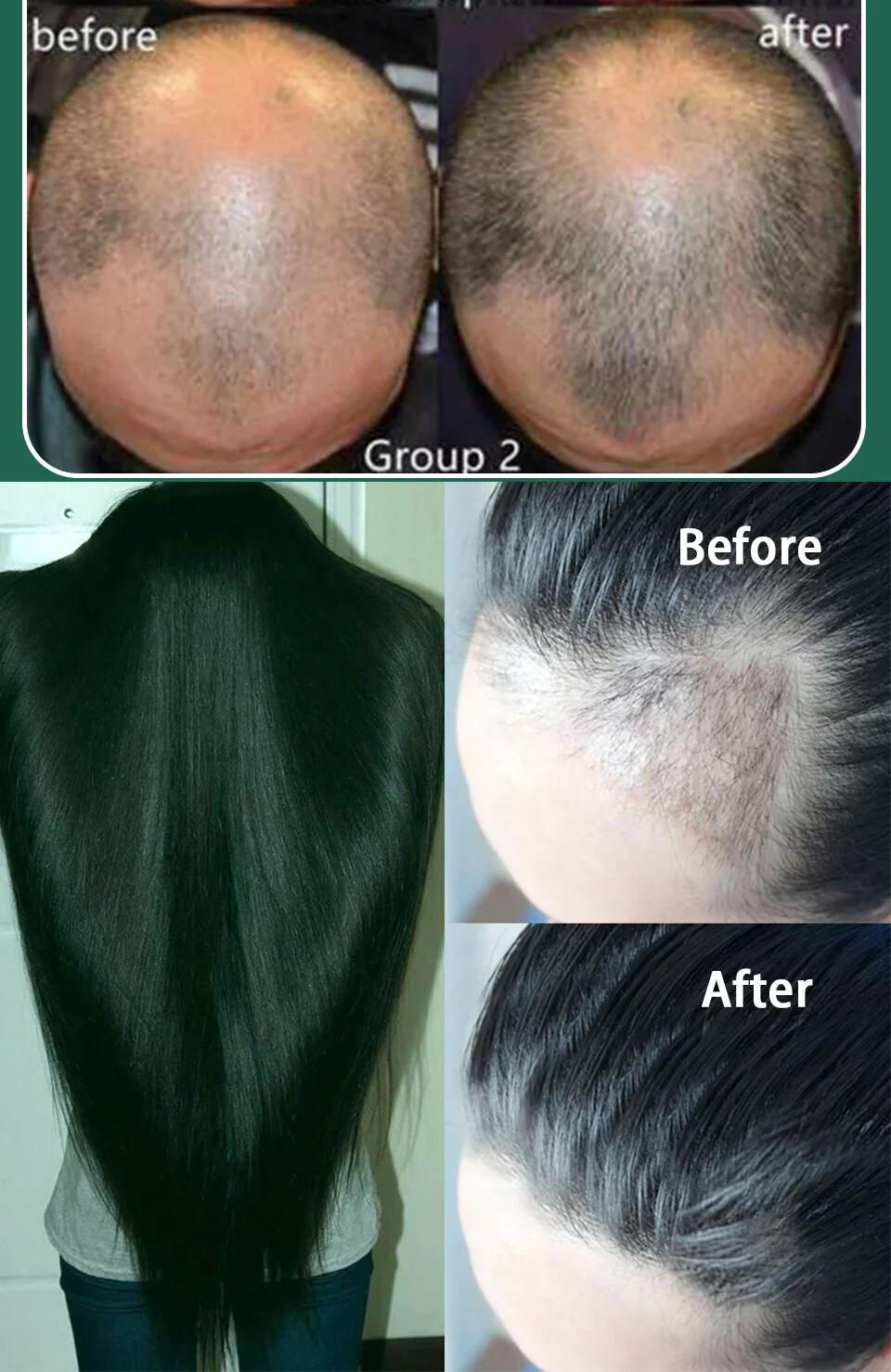 Miniatura: Fast Ginger Hair Growth Spray Roots Grow Anti Hair Loss Hair Regrowth Serum Scal