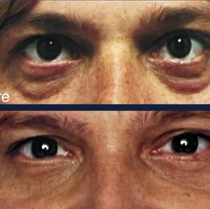Blepharoplasty
