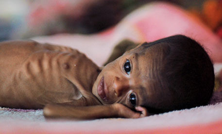 Malnourishment
