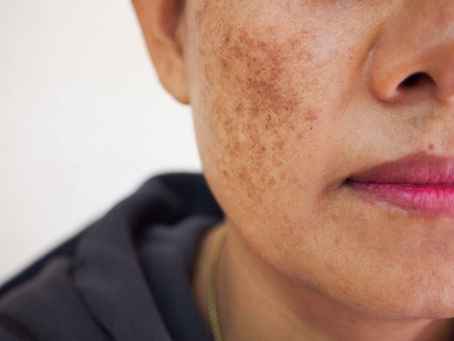 How to deal with Stubborn Hyperpigmentation
