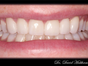 Final results of a smile transformed with natural looking porcelain veneers in Montebello by Dr. David Hakham 